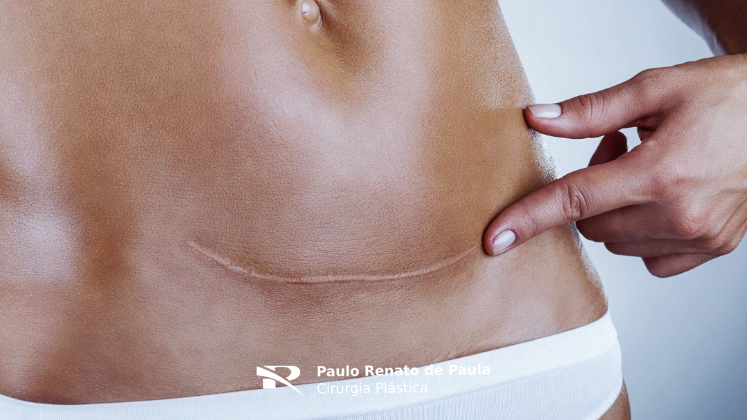 Cicatrizes após a Cirurgia Plástica – O que Determina a Qualidade?