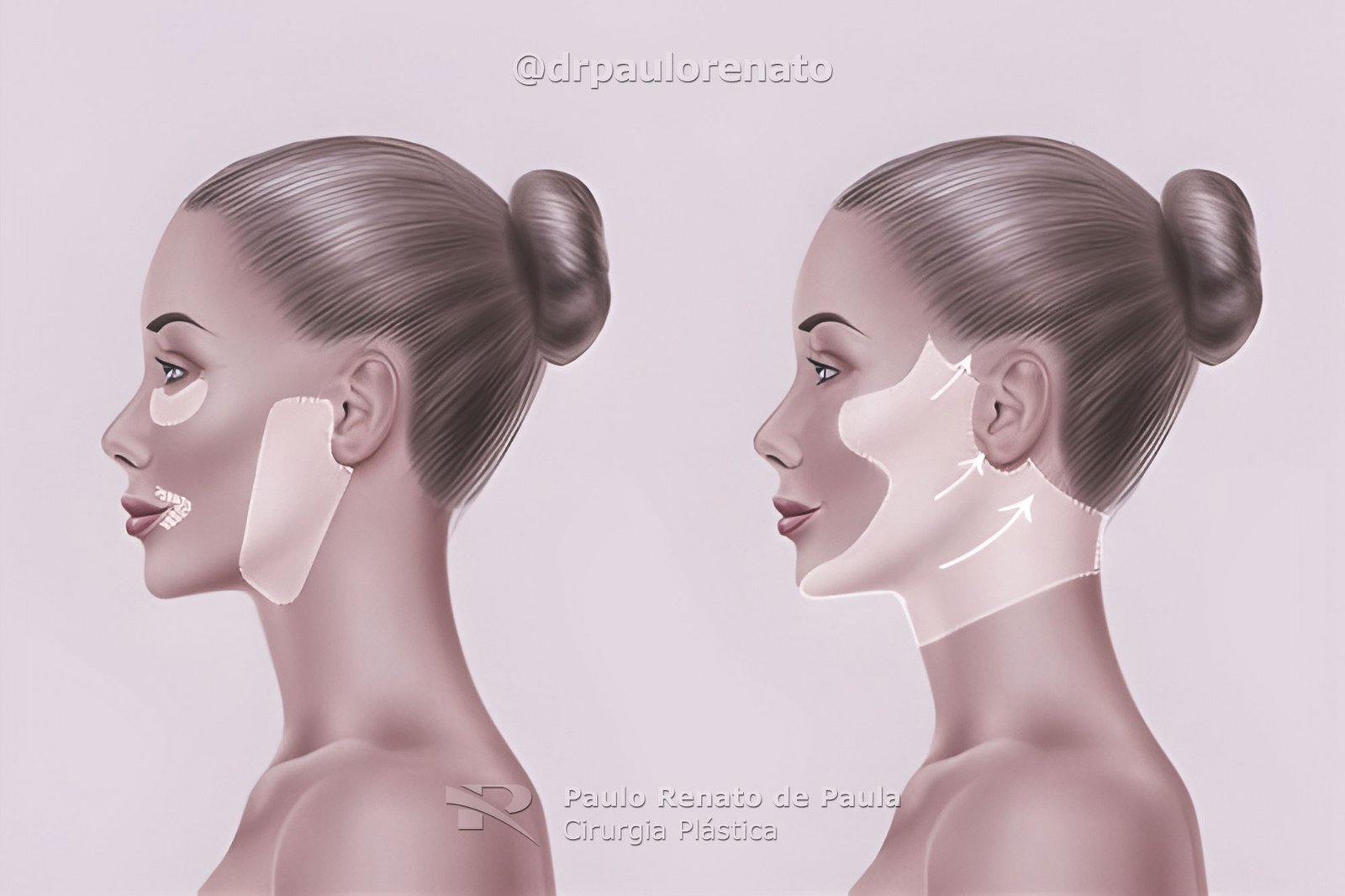 Deep Plane Lifting Facial Goiania Dr Paulo Renato Cirurgia Plastica