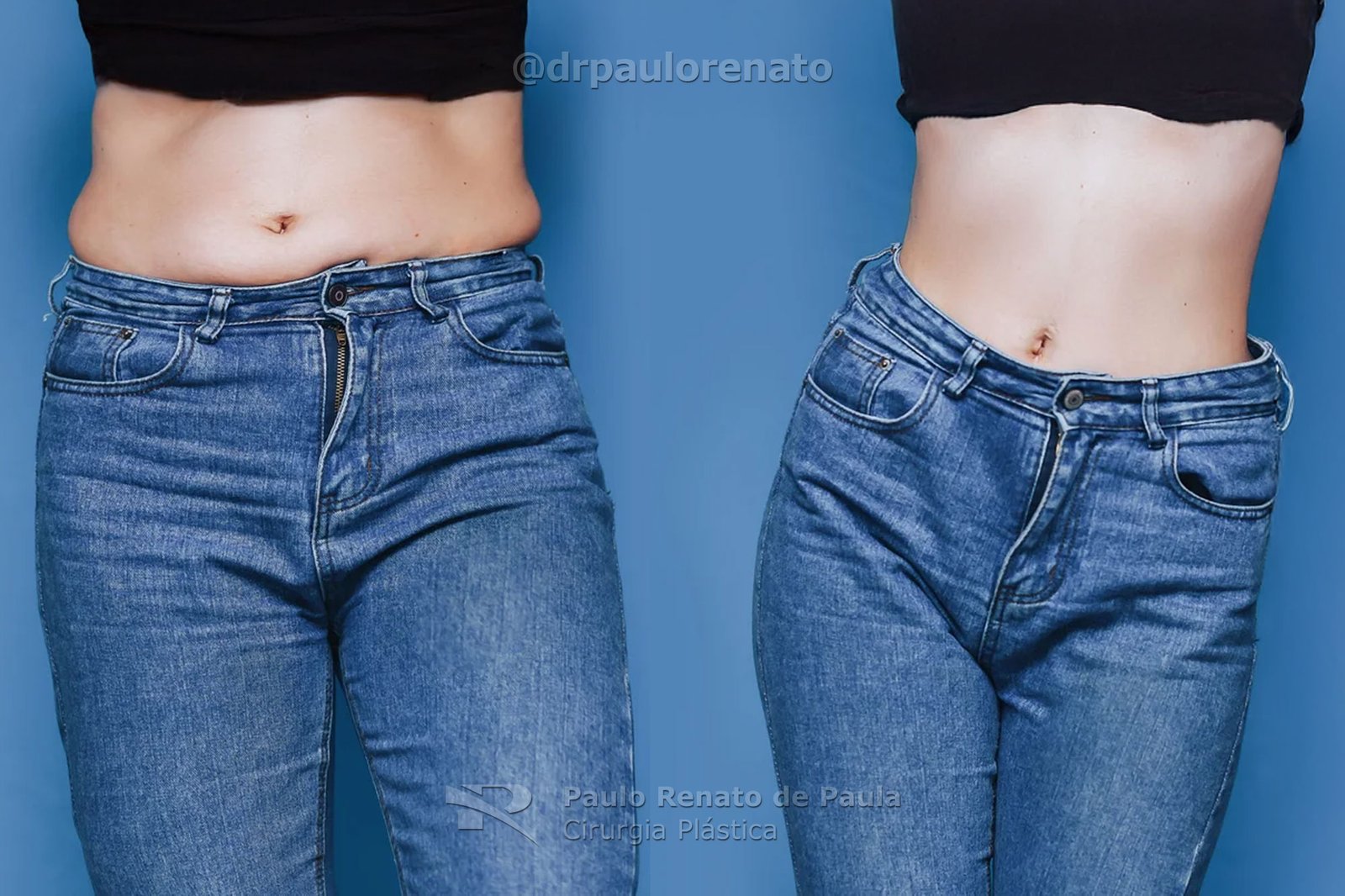 Como Evitar Seroma Apos Abdominoplastia Dr Paulo Renato De Paula Cirurgiao Plastico Goiania