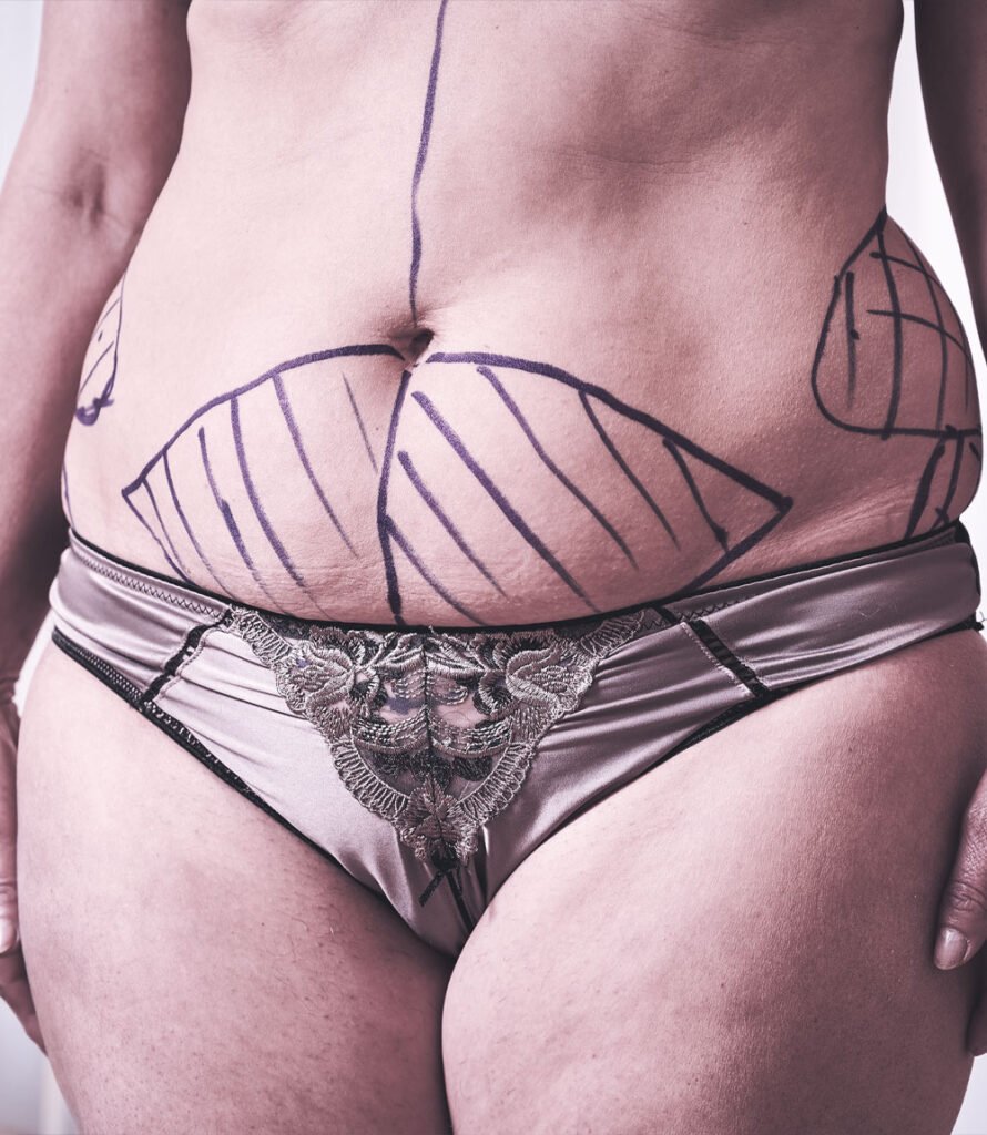 Cirurgia Plastica Lipoaspiracaol Goiania Dr Paulo Renato