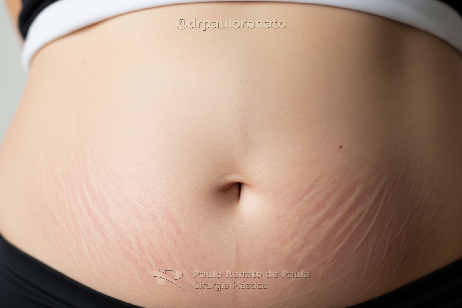 Eliminar Estrias Da Barriga Goiania Dr Paulo Renato Cirurgia Plastica